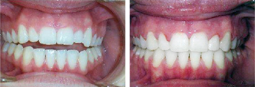 Before and after braces and Invisalign