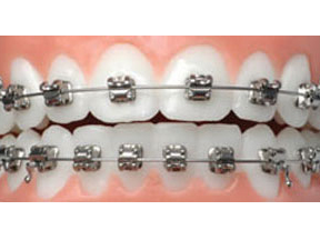 In-Ovation braces