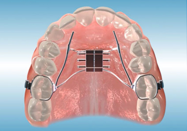 Palatal Expander