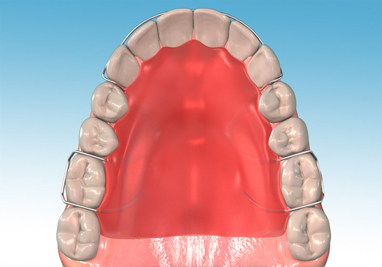 Removable Retainer