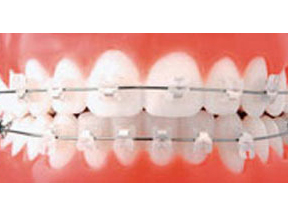 In-Ovation braces