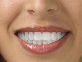 Invisalign clear braces