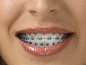 Traditional metal braces