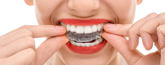 The Invisalign process