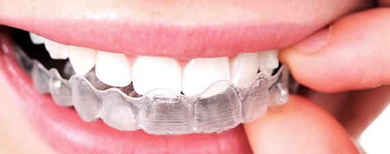 Invisalign clear braces in Fresno