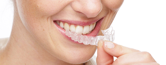 Reasons to choose Invisalign clear braces